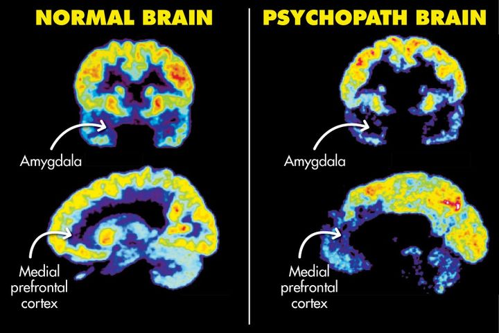 Brain Structural and Functional Anomalies in Psychopaths