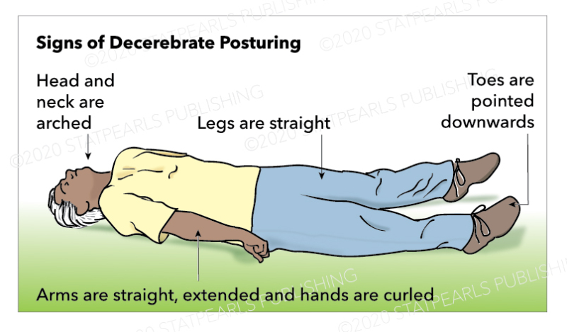 Signs Of Decorticate